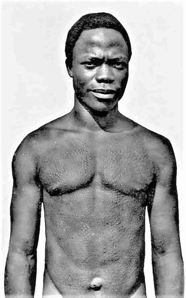 Ecarificaciones torsos